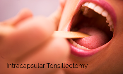 Intracapsular Tonsillectomy